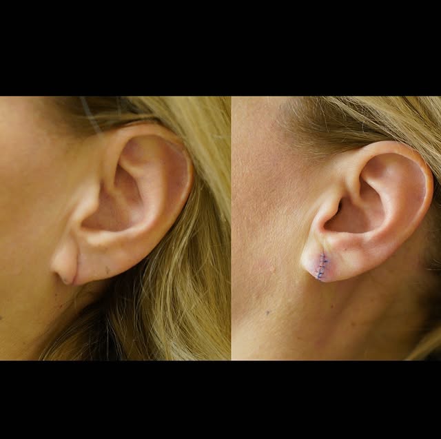 Before and After Image: Earlobe Repair - left-side