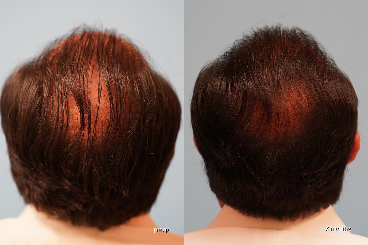 Before and After Image: Hair Transplantation - back