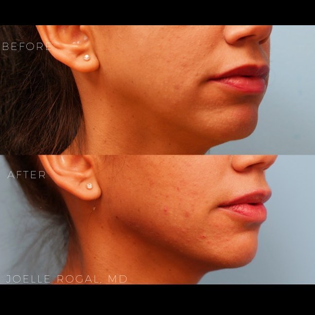 Before and After Image: Jawline Contouring with fillers - right-front-oblique