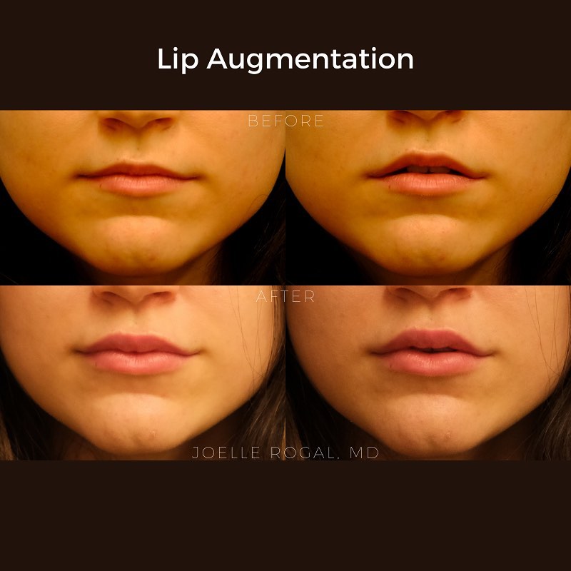 Before and After Image: Lip Augmentation - front