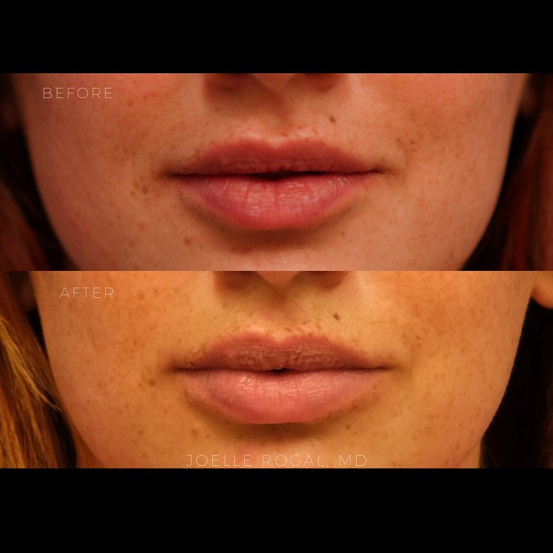 Before and After Image: Lip Augmentation - front