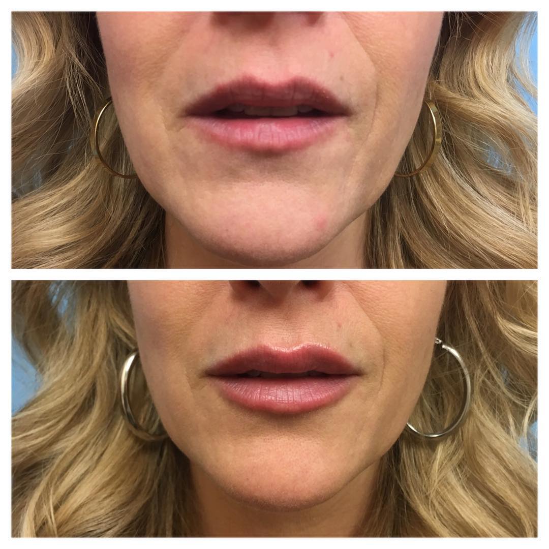 Before and After Image: Lip Augmentation - front