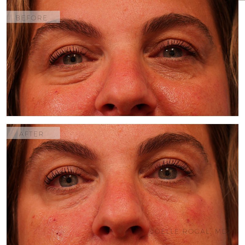 Before and After Image: Natural and subtle under eye fillers - front