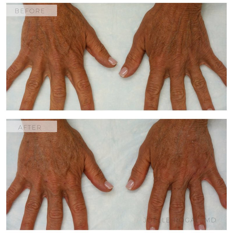 Before and After Image: Natural Hand Rejuvenation using Restylane Lyft - front