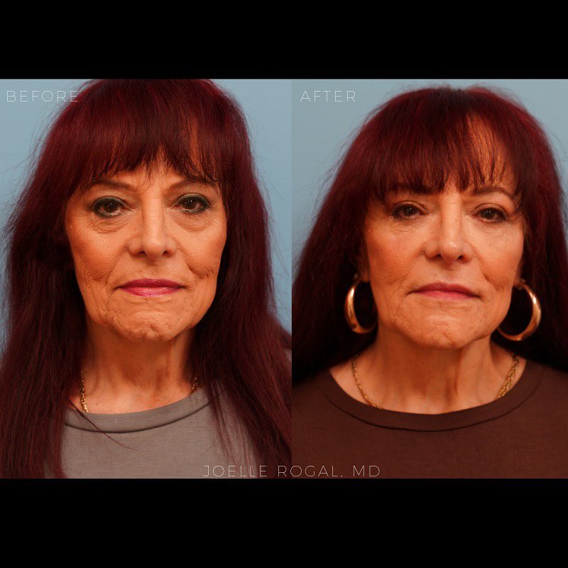 Before and After Image: Non-surgical Facial Rejuvenation - front