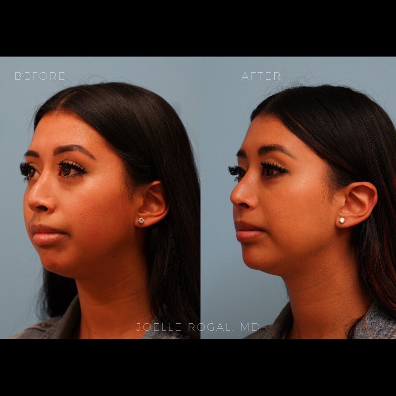 Before and After Image: Non-surgical Chin and Jawline Contouring - left-front-oblique