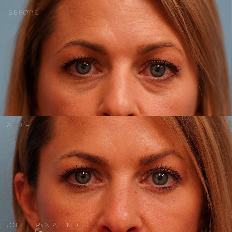 Before and After Image: Nonsurgical correction of under eye dark circles using fillers - front