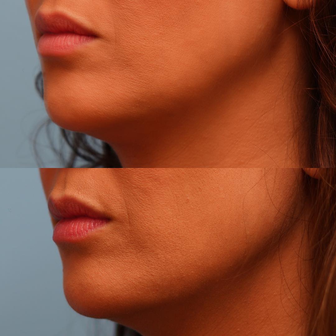 Before and After Image: Subtle Jawline Contouring - left-front-oblique