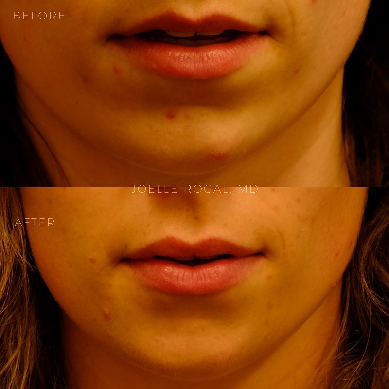 Before and After Image: Subtle and natural nonsurgical lip and chin augmentation - front