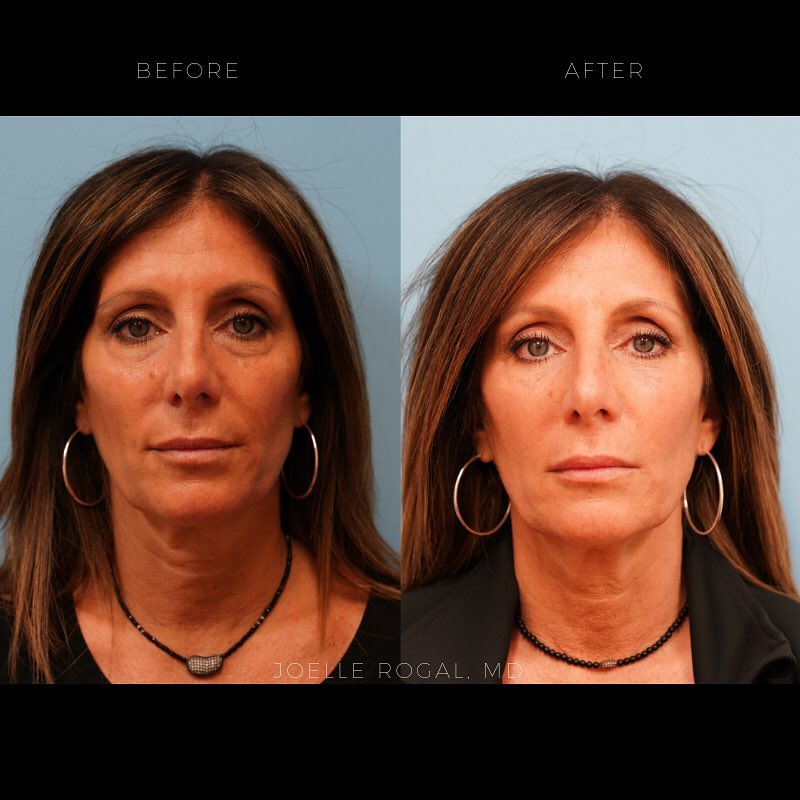 Before and After Image: Undereye Circle Correction – Hyaluronic Acid Filler - front