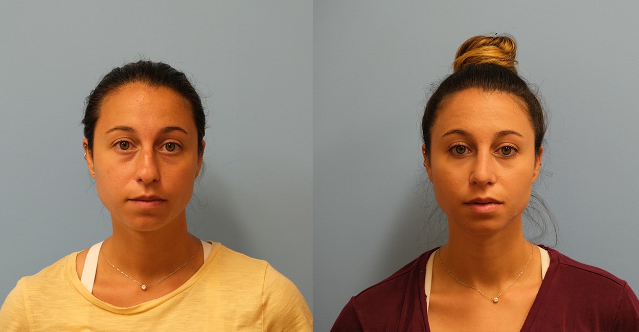 Before and After Image: Rhinoplasty - front