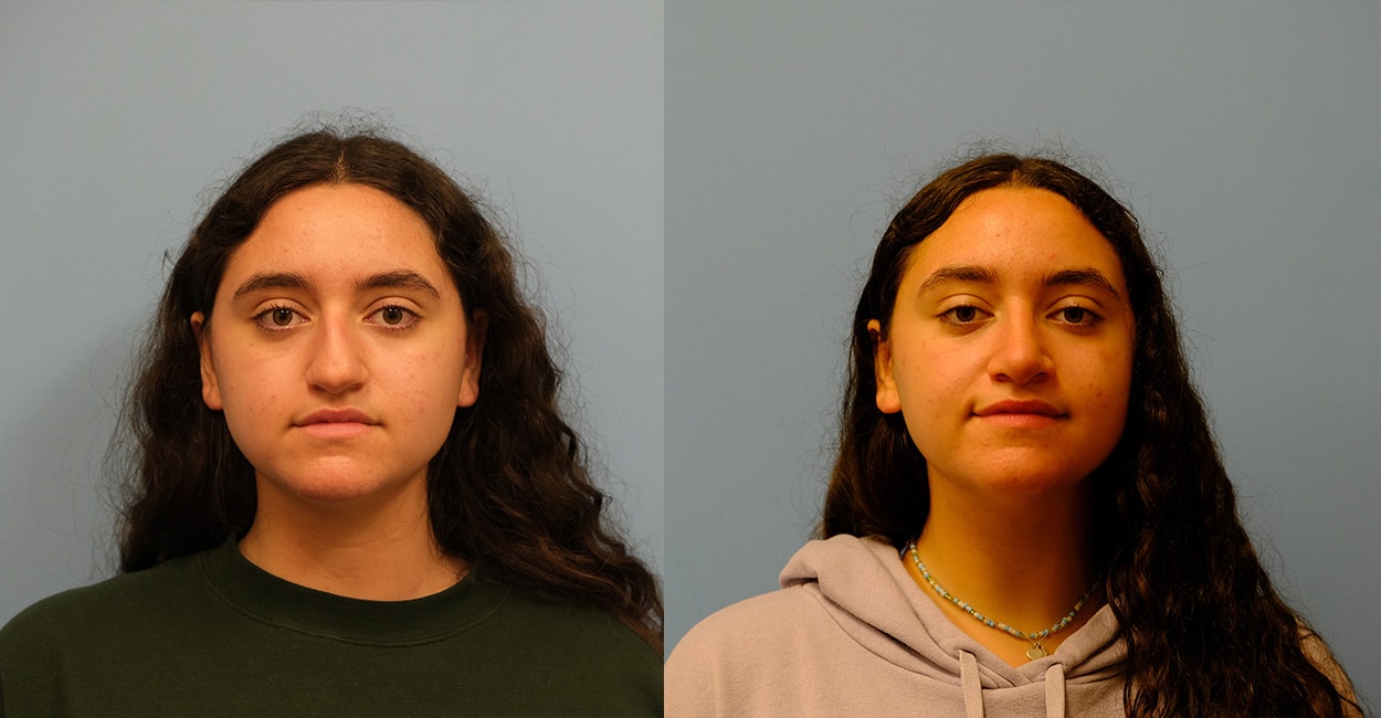 Before and After Image: Rhinoplasty - left-side