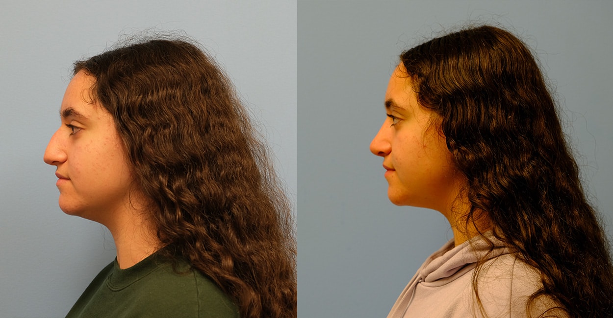 Before and After Image: Rhinoplasty - left-side