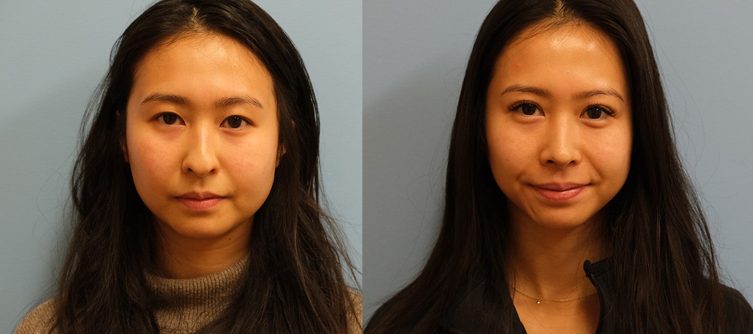 Before and After Image: Rhinoplasty - front
