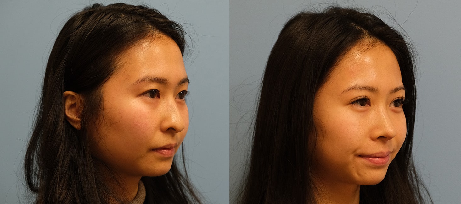 Before and After Image: Rhinoplasty - right-front-oblique