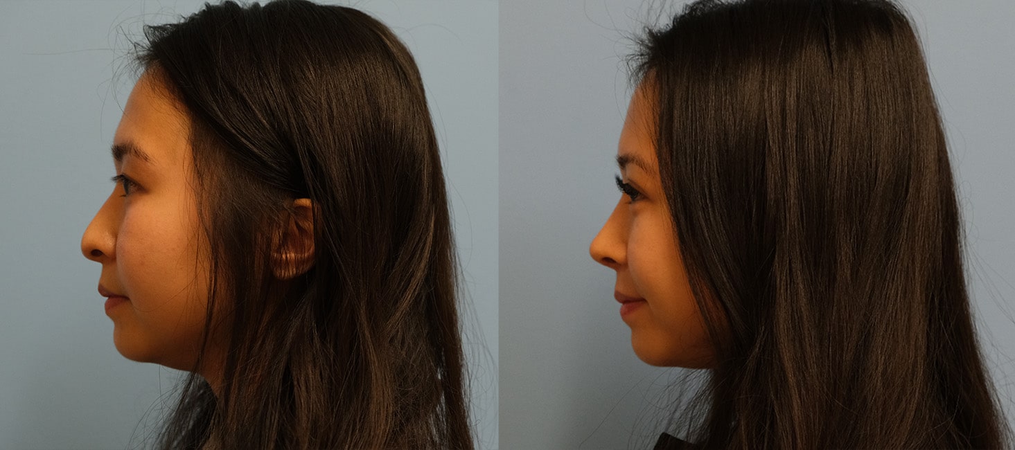 Before and After Image: Rhinoplasty - left-side