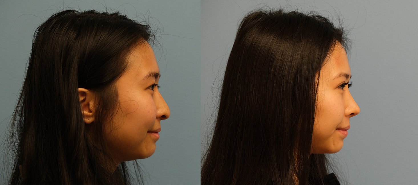 Before and After Image: Rhinoplasty - right-side