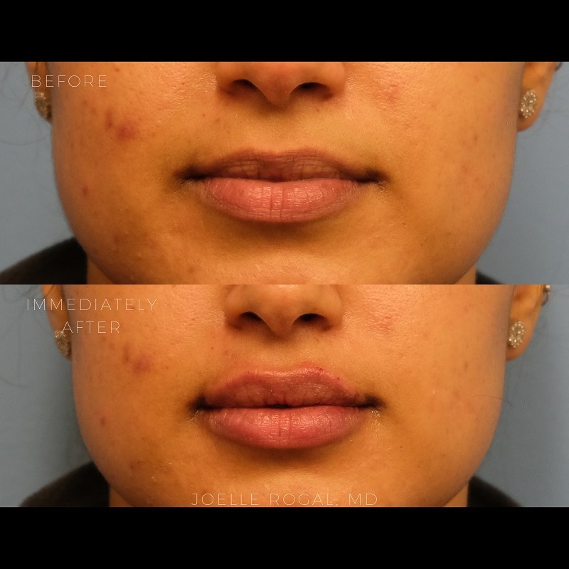 Before and After Image: Lip Augmentation and Volume in Lips - front