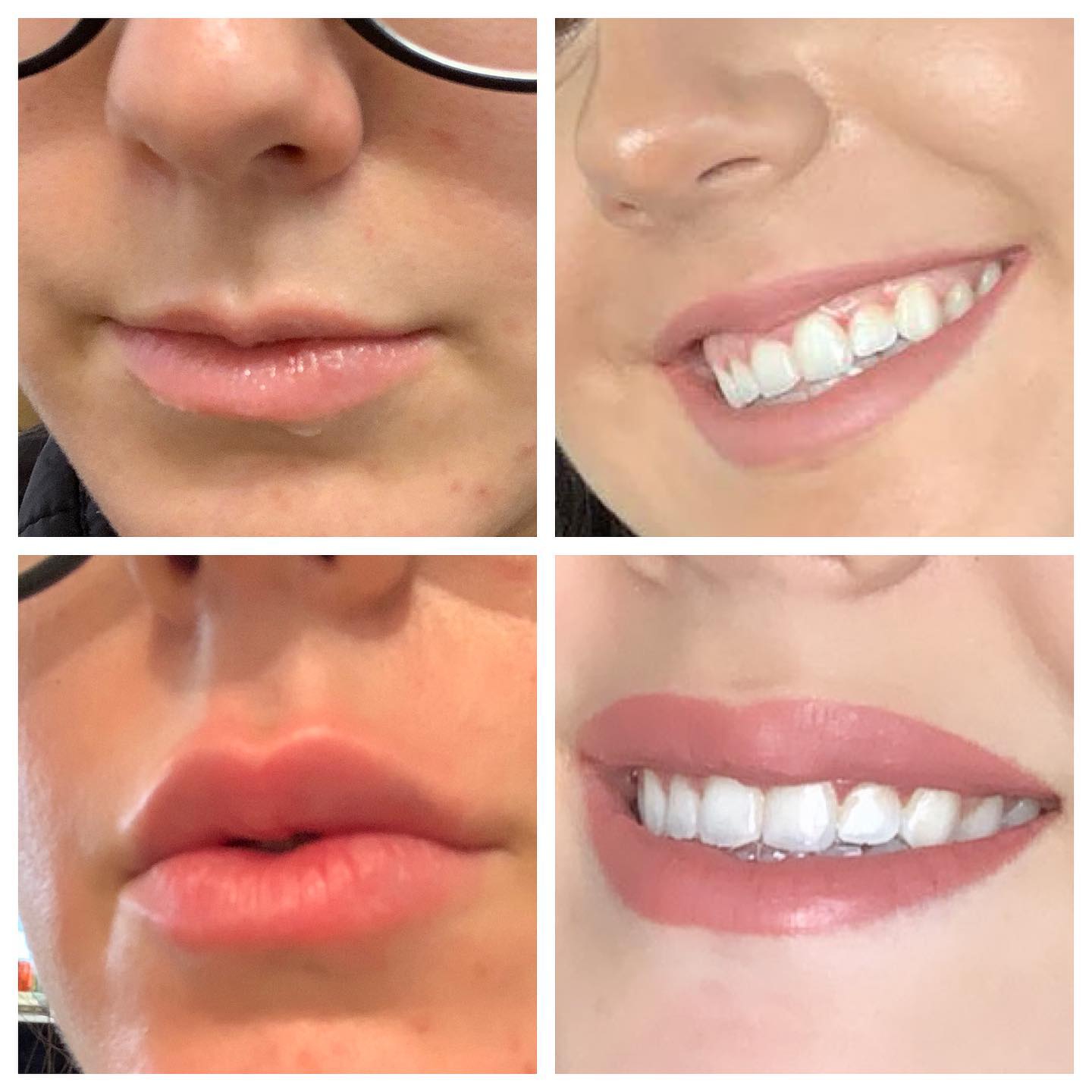 Before and After Image: Lip Augmentation with Injectable Fillers - front