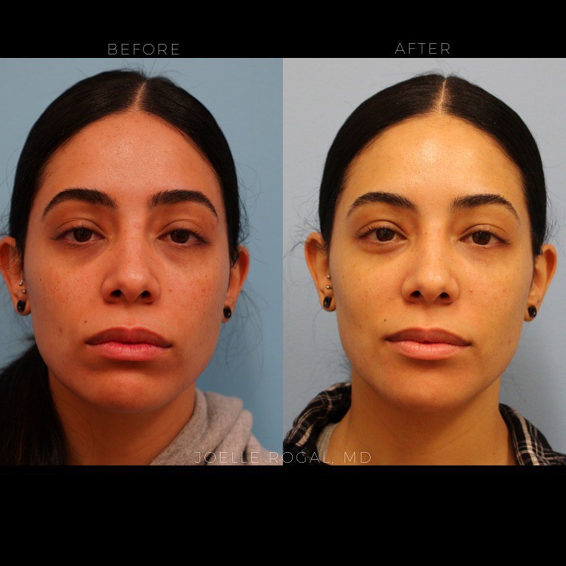 Before and After Image: Undereye filler treatment as well as filler to the lower face - front