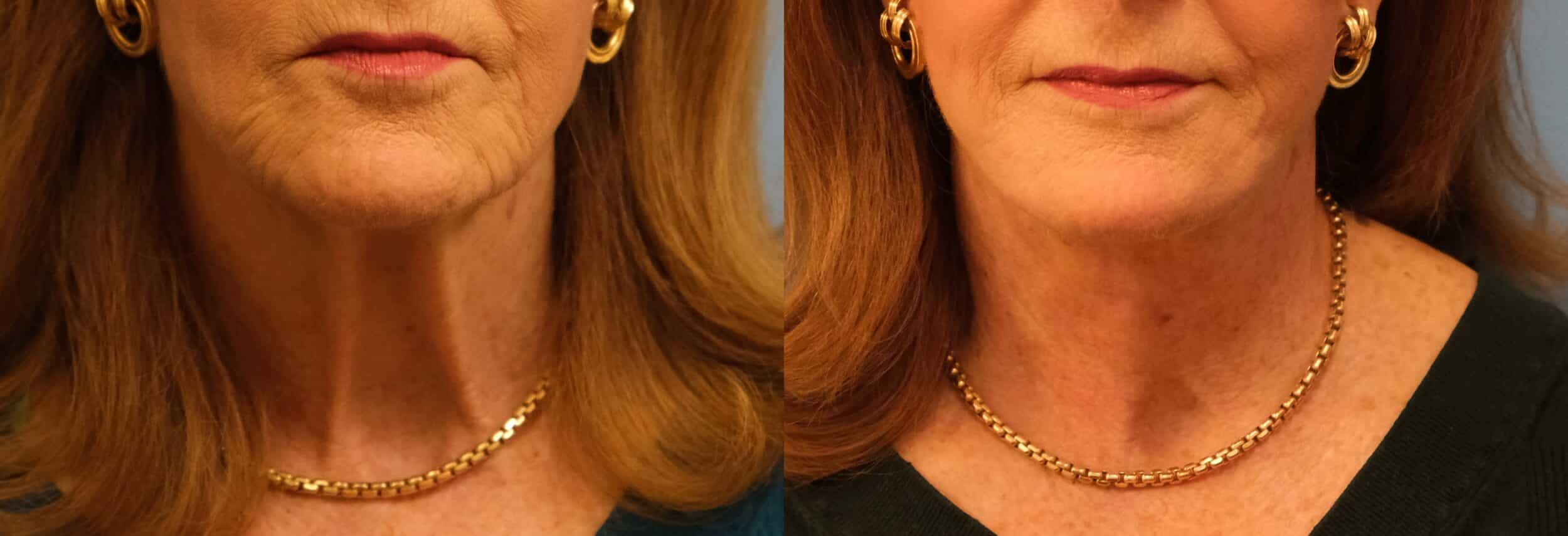 Before and After Image: Facelift - front