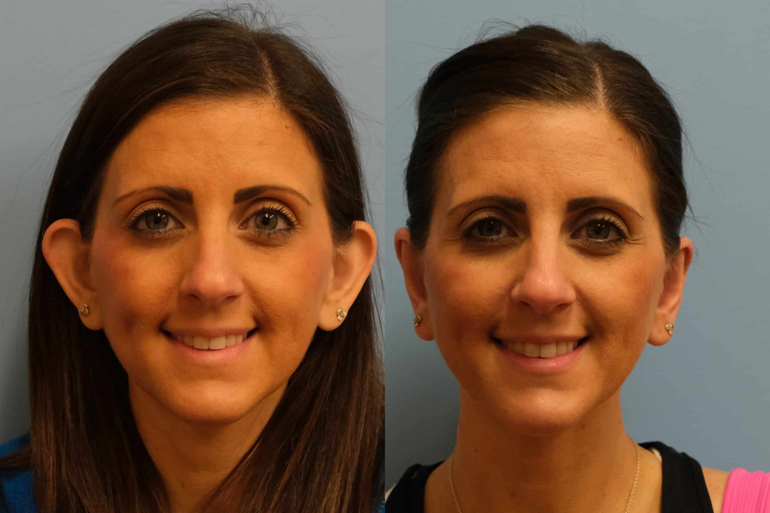 Before and After Image: Otoplasty - front