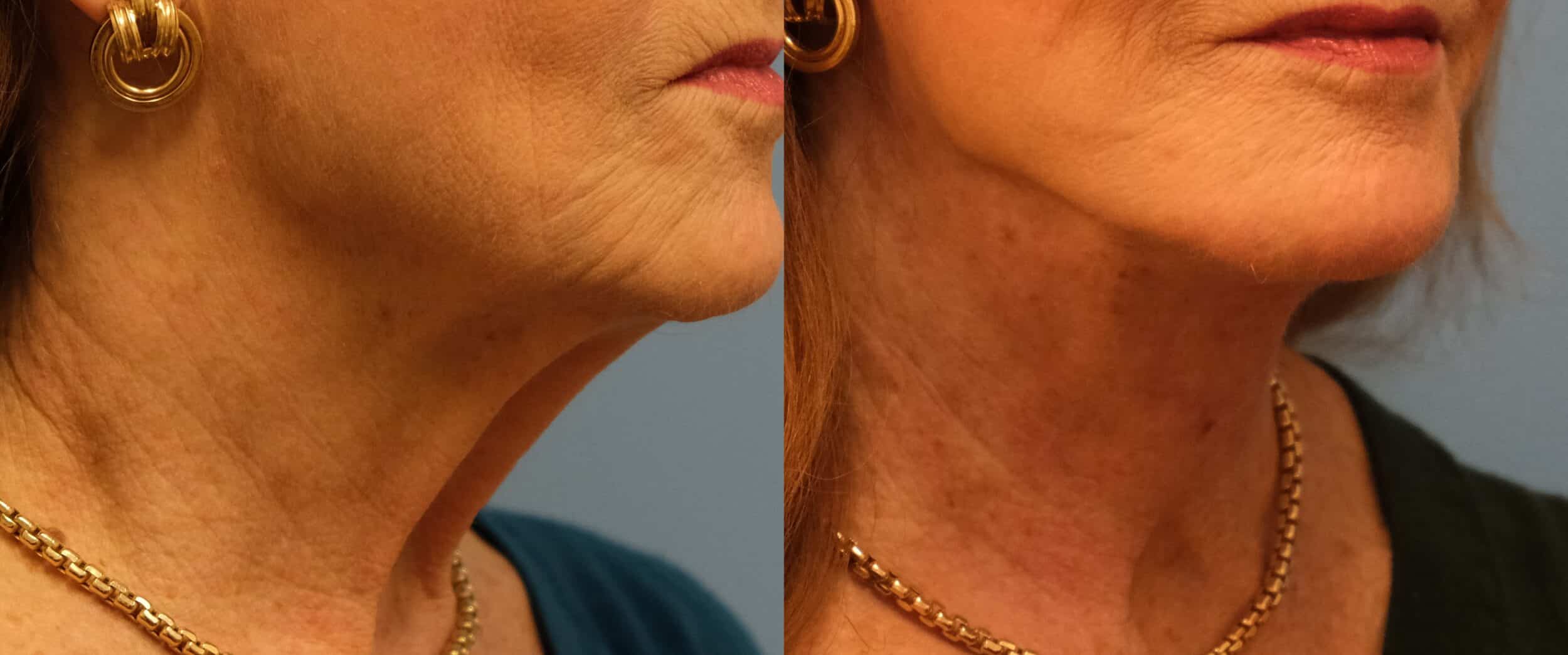 Before and After Image: Facelift - right-front-oblique