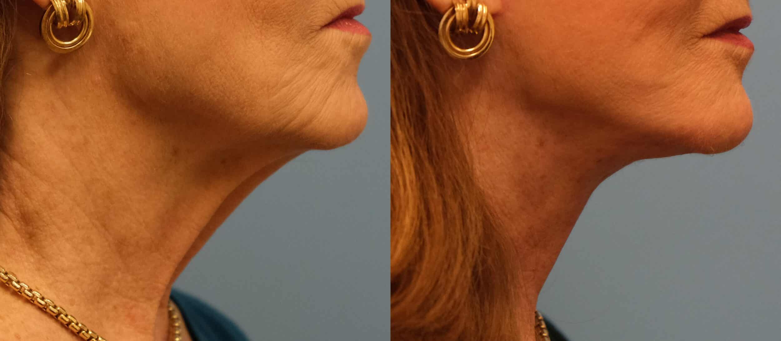 Before and After Image: Facelift - right-side