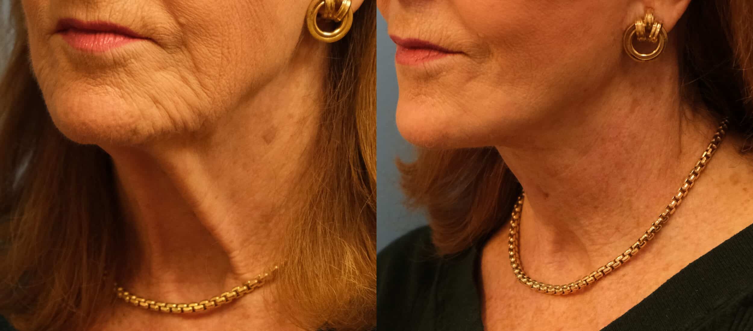 Before and After Image: Facelift - left-front-oblique