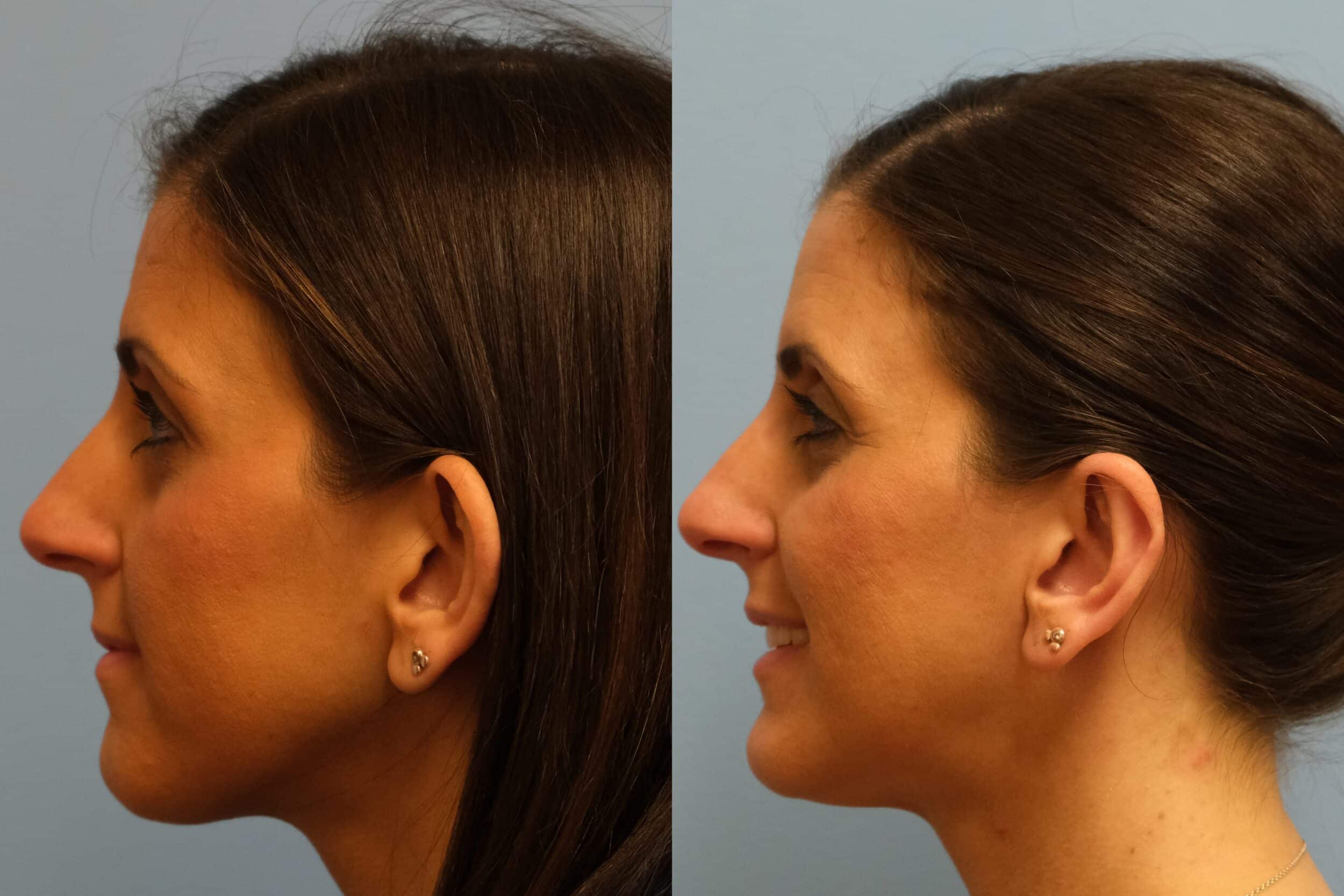 Before and After Image: Otoplasty - left-side