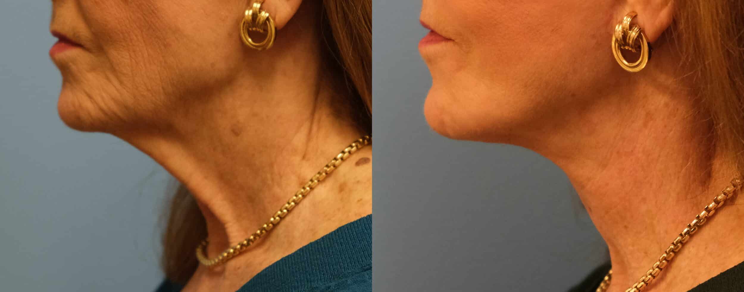 Before and After Image: Facelift - left-side