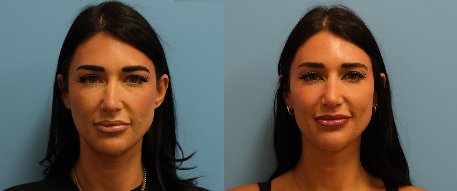 Before and After Image: Rhinoplasty - front