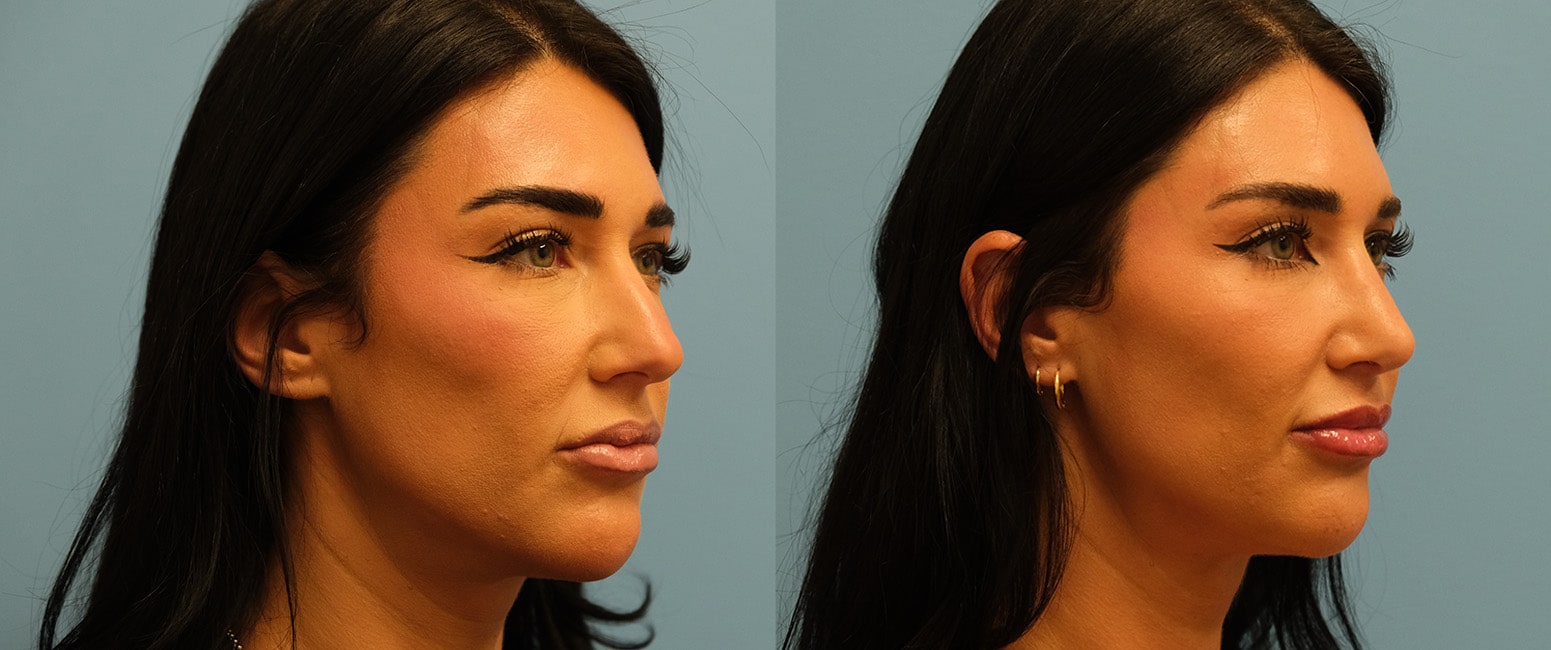 Before and After Image: Rhinoplasty - right-front-oblique