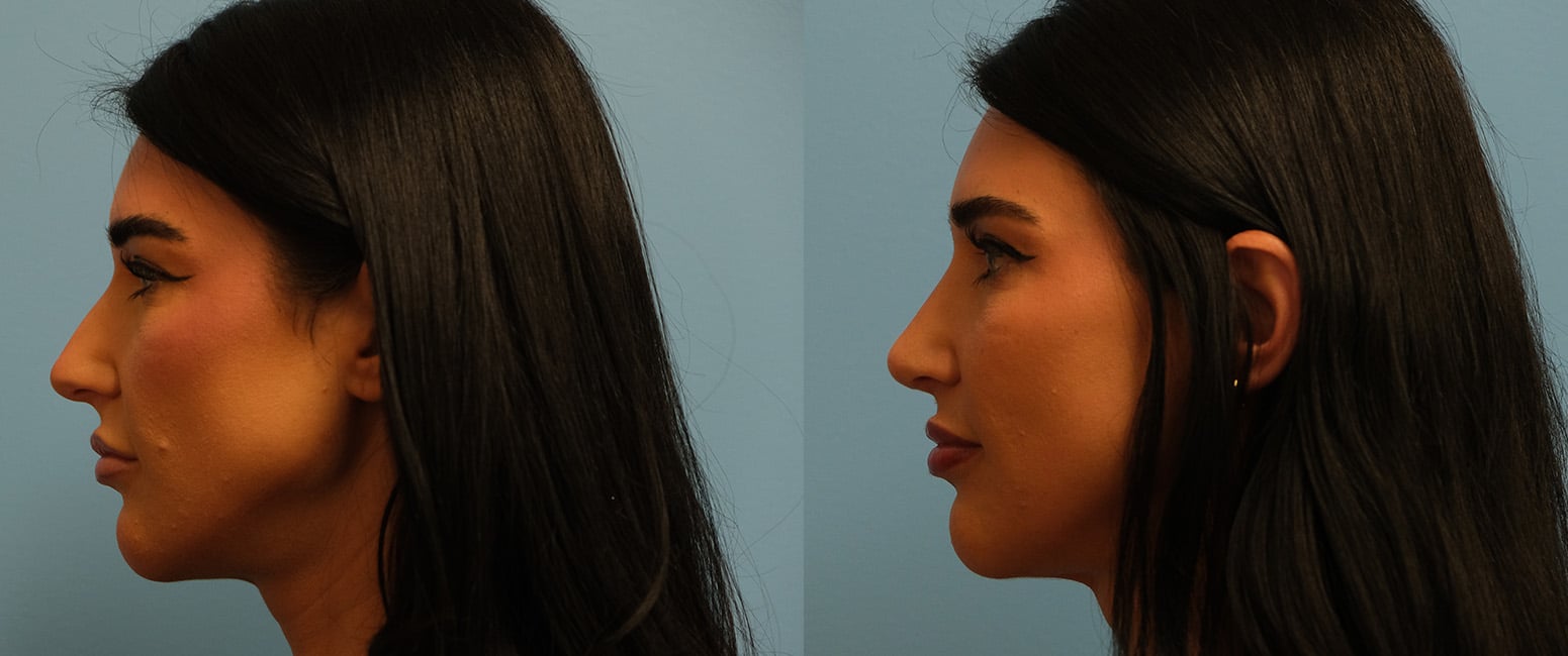Before and After Image: Rhinoplasty - left-side