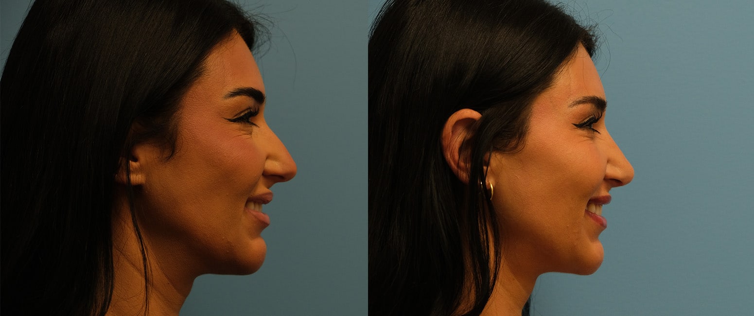 Before and After Image: Rhinoplasty - right-side