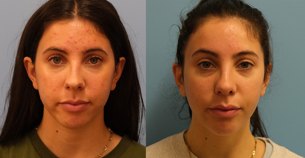 Before and After Image: Rhinoplasty - front