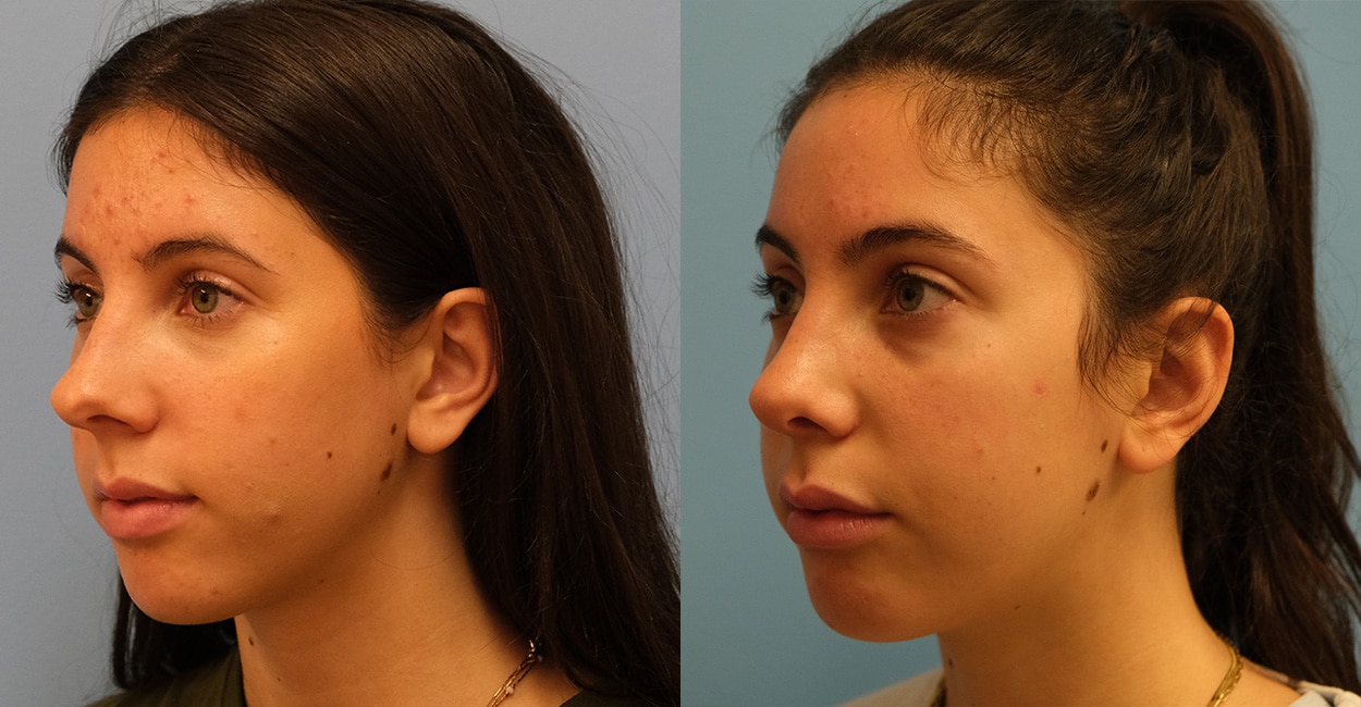 Before and After Image: Rhinoplasty - left-front-oblique