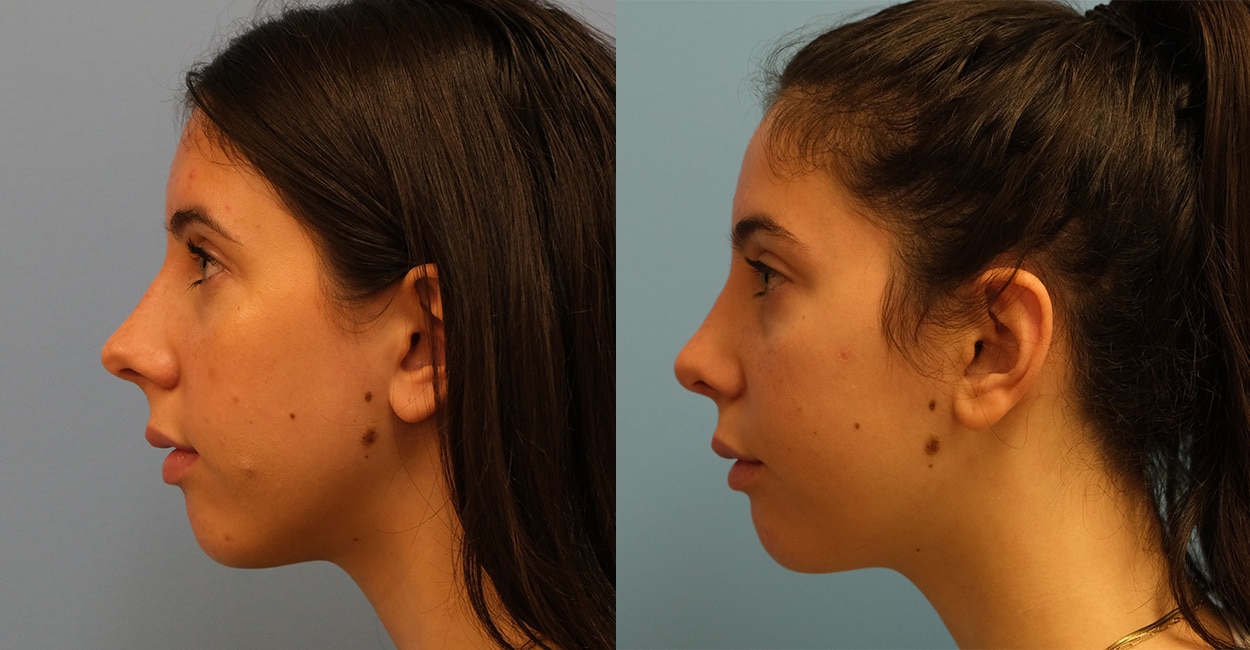 Before and After Image: Rhinoplasty - left-side