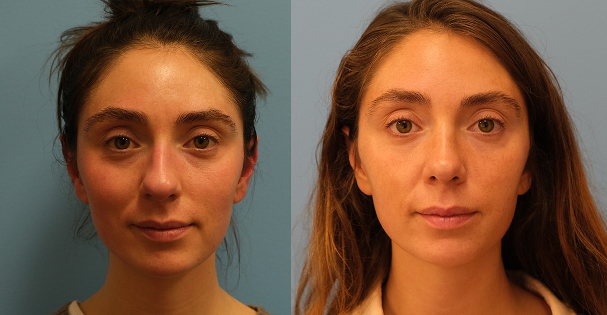 Before and After Image: Rhinoplasty - front