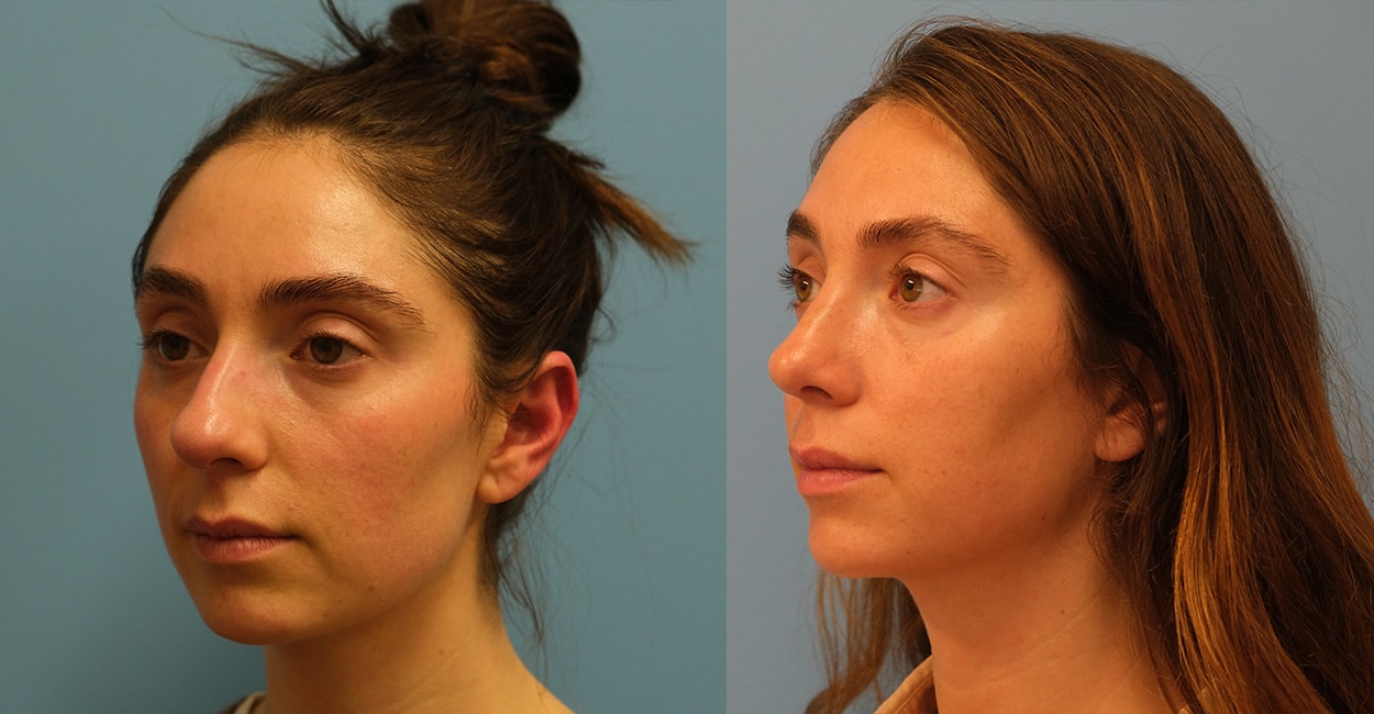 Before and After Image: Rhinoplasty - left-front-oblique