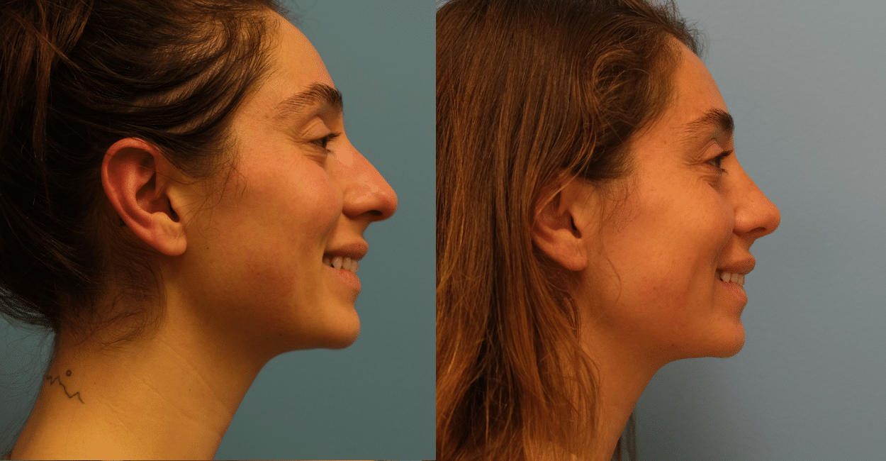 Before and After Image: Rhinoplasty - right-side