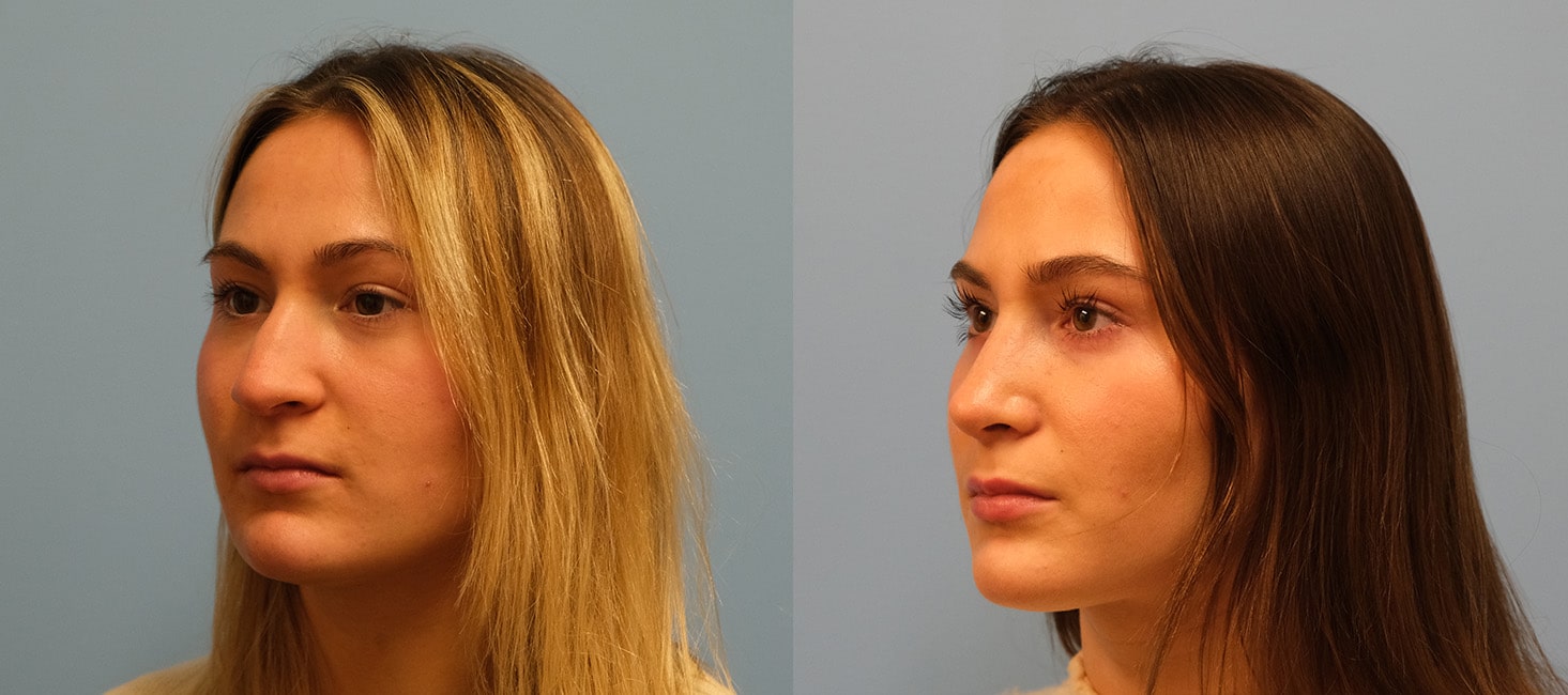 Before and After Image: Rhinoplasty - left-front-oblique