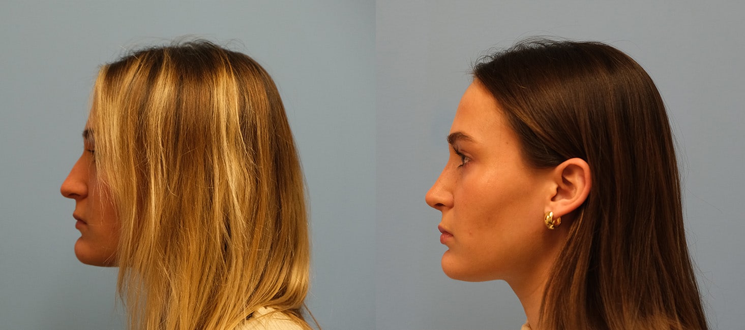 Before and After Image: Rhinoplasty - left-side