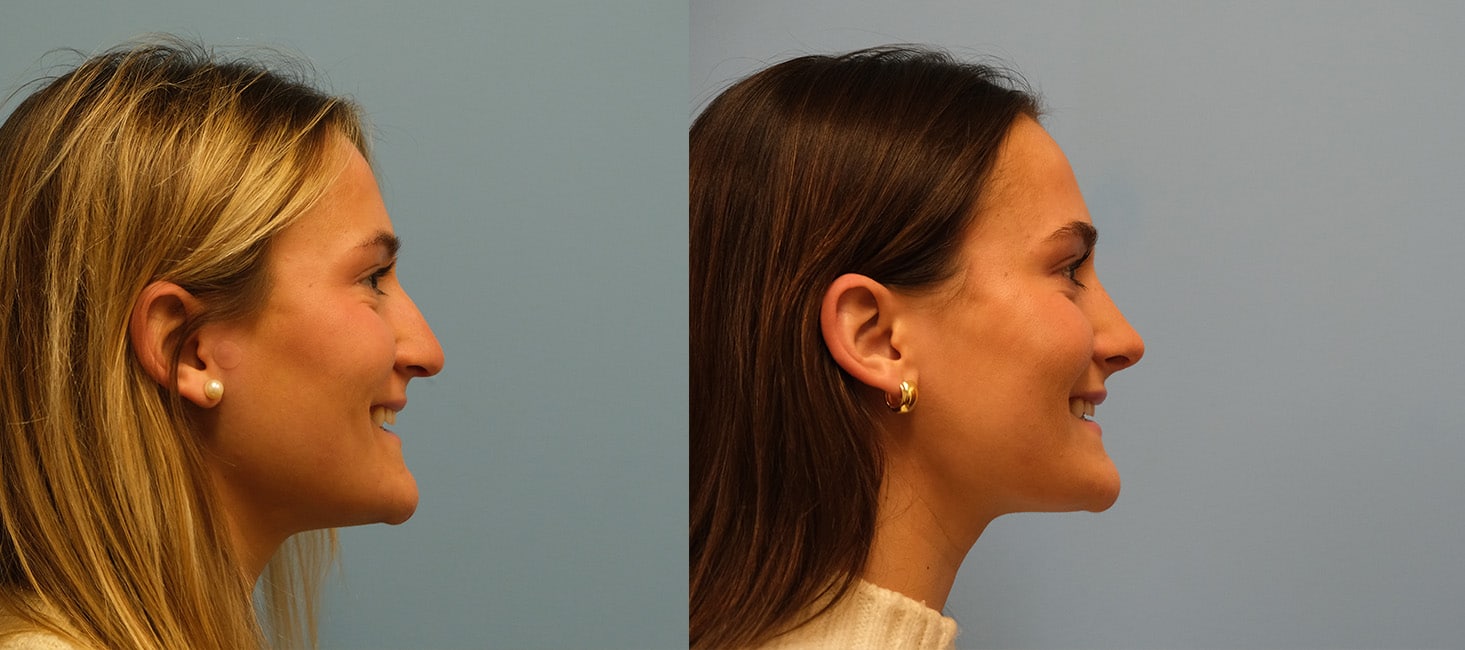 Before and After Image: Rhinoplasty - right-side