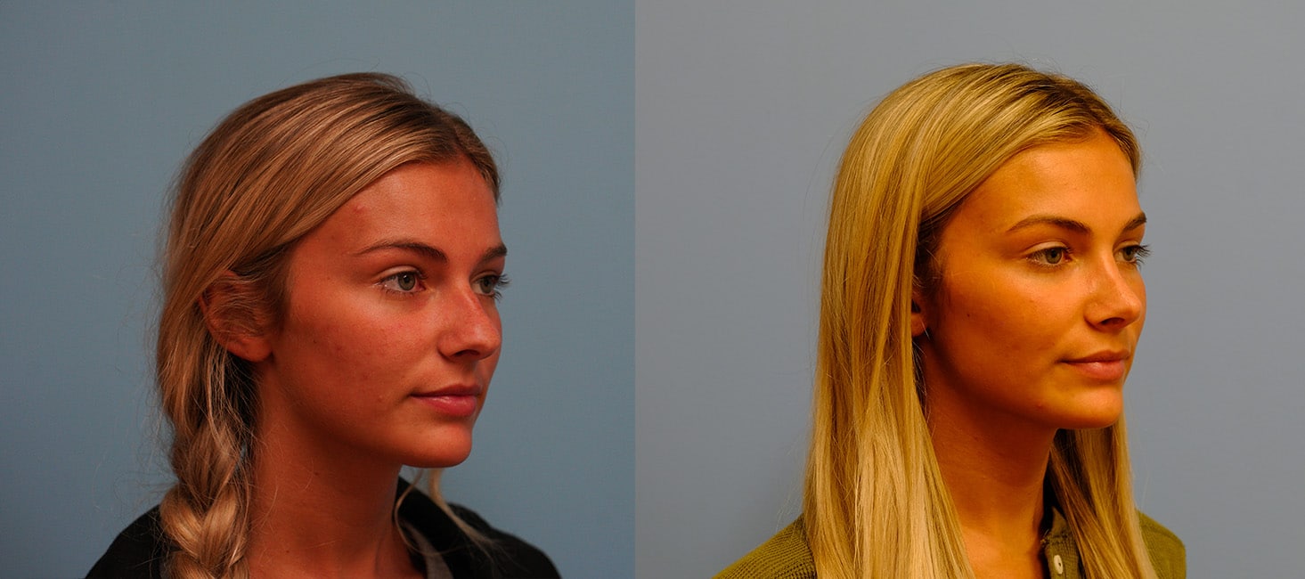 Before and After Image: Rhinoplasty - right-front-oblique