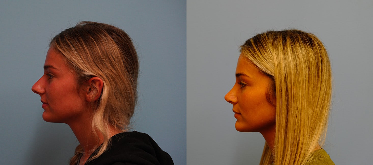 Before and After Image: Rhinoplasty - left-side