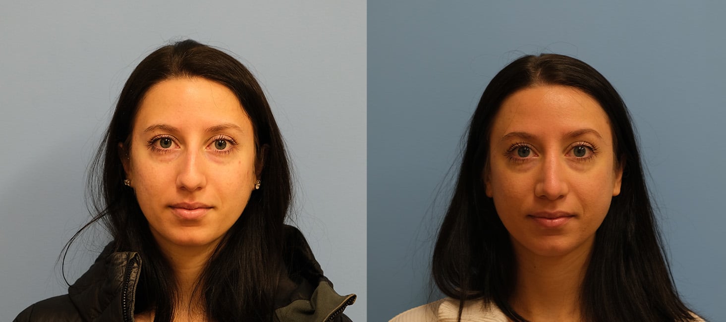 Before and After Image: Rhinoplasty - front