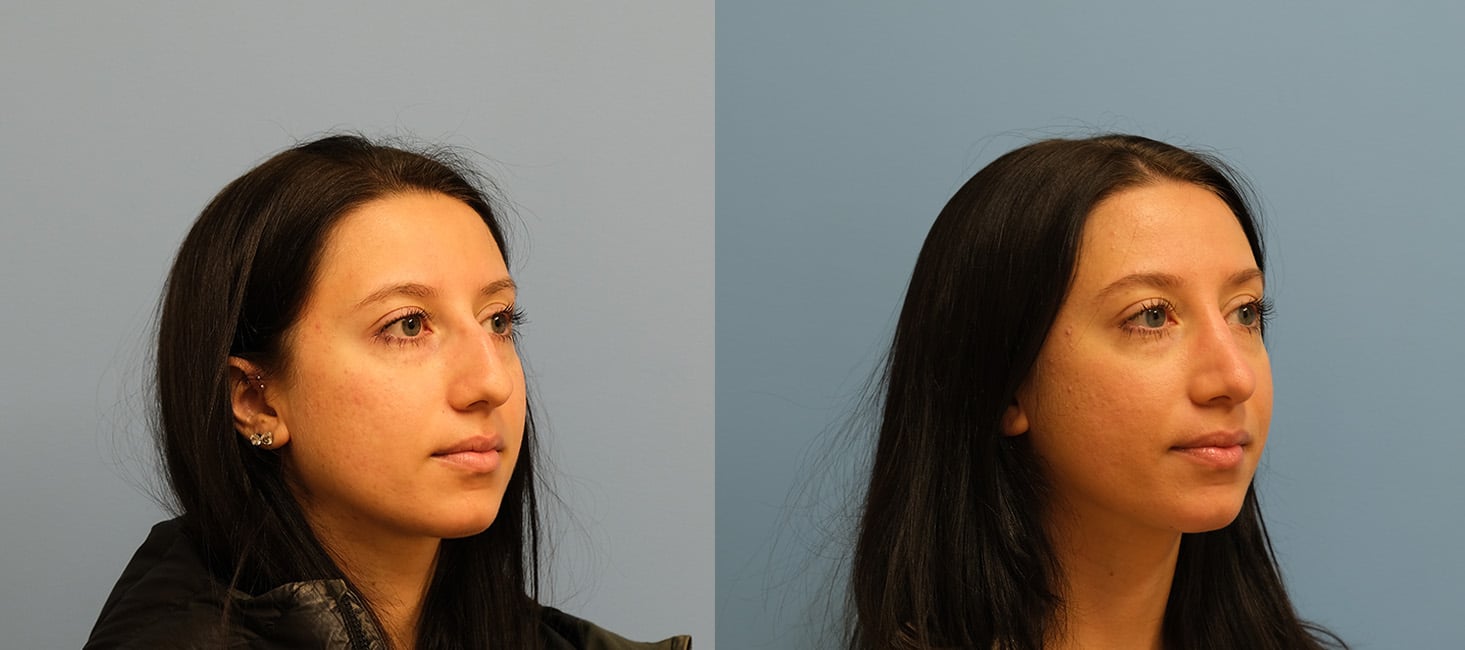 Before and After Image: Rhinoplasty - right-front-oblique