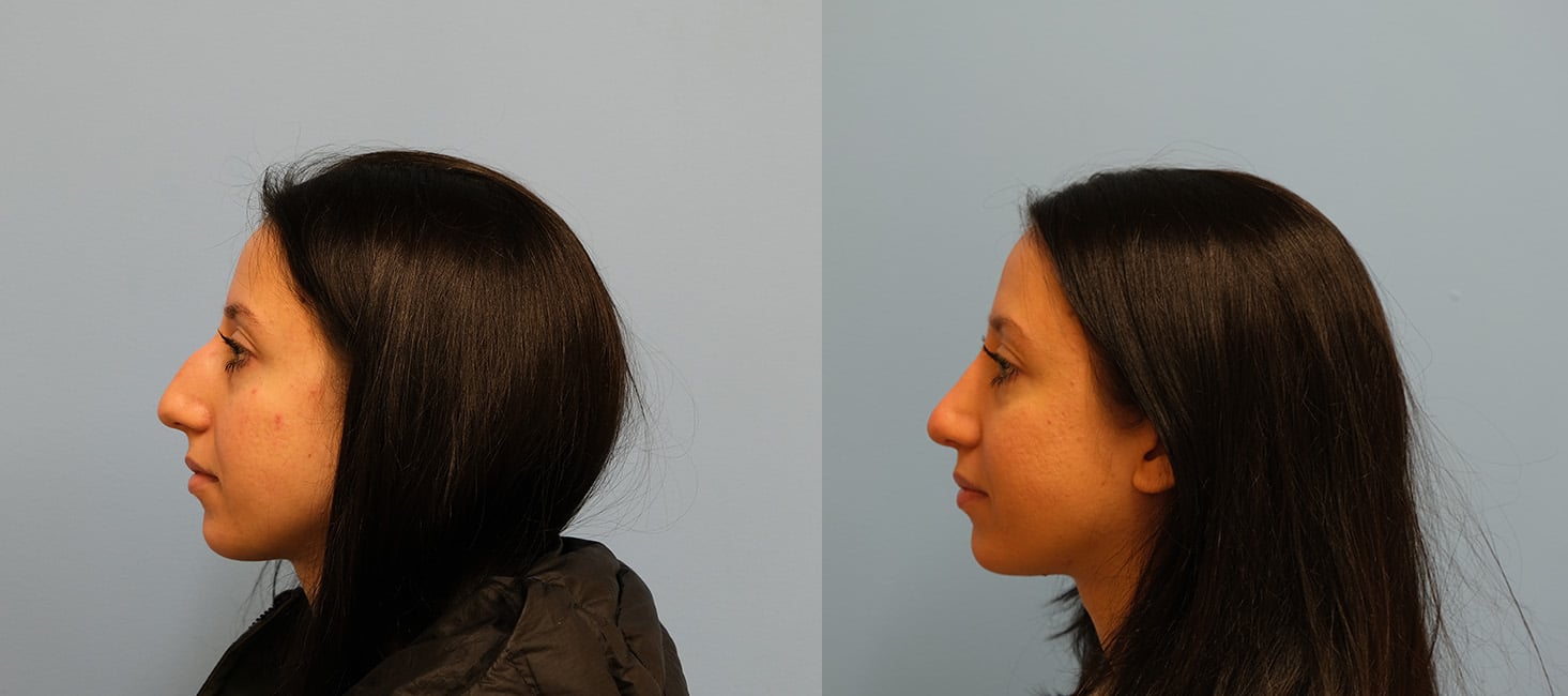 Before and After Image: Rhinoplasty - left-side