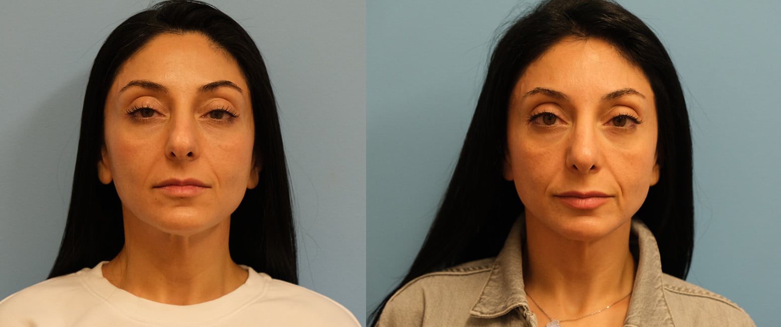 Before and After Image: Rhinoplasty - front